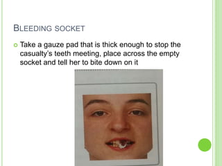 BLEEDING SOCKET
 Take a gauze pad that is thick enough to stop the
casualty’s teeth meeting, place across the empty
socket and tell her to bite down on it
 