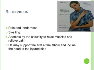 RECOGNITION
 Pain and tenderness
 Swelling
 Attempts by the casualty to relax muscles and
relieve pain
 He may support the arm at the elbow and incline
the head to the injured side
 