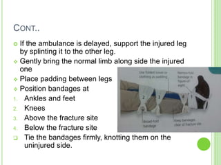 CONT..
 If the ambulance is delayed, support the injured leg
by splinting it to the other leg.
 Gently bring the normal limb along side the injured
one
 Place padding between legs
 Position bandages at
1. Ankles and feet
2. Knees
3. Above the fracture site
4. Below the fracture site
 Tie the bandages firmly, knotting them on the
uninjured side.
 