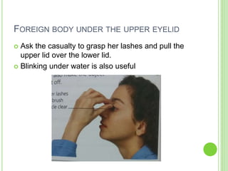 FOREIGN BODY UNDER THE UPPER EYELID
 Ask the casualty to grasp her lashes and pull the
upper lid over the lower lid.
 Blinking under water is also useful
 