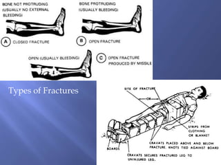 Types of Fractures

 