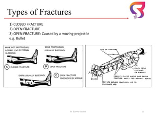 Types of Fractures
Dr. Sushma Kaushal 22
1) CLOSED FRACTURE
2) OPEN FRACTURE
3) OPEN FRACTURE: Caused by a moving projectile
e.g. Bullet
 