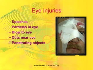 Eye Injuries
– Splashes
– Particles in eye
– Blow to eye
– Cuts near eye
– Penetrating objects
Asra Hameed (trainee at CDL)
 