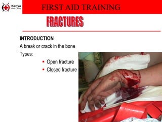 FIRST AID TRAINING
INTRODUCTION
A break or crack in the bone
Types:
 Open fracture
 Closed fracture
 