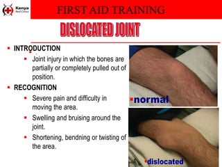 FIRST AID TRAINING
 .
 INTRODUCTION
 Joint injury in which the bones are
partially or completely pulled out of
position.
 RECOGNITION
 Severe pain and difficulty in
moving the area.
 Swelling and bruising around the
joint.
 Shortening, bendning or twisting of
the area.
 