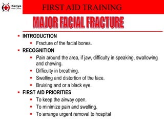 FIRST AID TRAINING
 INTRODUCTION
 Fracture of the facial bones.
 RECOGNITION
 Pain around the area, if jaw, difficulty in speaking, swallowing
and chewing.
 Difficulty in breathing.
 Swelling and distortion of the face.
 Bruising and or a black eye.
 FIRST AID PRIORITIES
 To keep the airway open.
 To minimize pain and swelling.
 To arrange urgent removal to hospital
 
