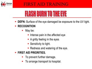 FIRST AID TRAINING
 DEFN: Surface of the eye damaged be exposure to the UV light.
 RECOGNITION
 May be:
 Intense pain in the affected eye
 A gritty feeling in the eyes
 Sensitivity to light.
 Redness and watering of the eye.
 FIRST AID PRIORITIES.
 To prevent further damage.
 To arrange transport to hospital.
 