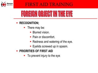 FIRST AID TRAINING
 RECOGNITION;
 There may be:
 Blurred vision.
 Pain or discomfort.
 Redness and watering of the eye.
 Eyelids screwed up in spasm.
 PRIORITIES OF FIRST AID
 To prevent injury to the eye.
 