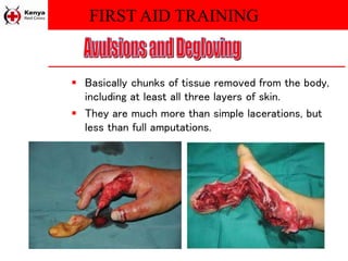 FIRST AID TRAINING
 Basically chunks of tissue removed from the body,
including at least all three layers of skin.
 They are much more than simple lacerations, but
less than full amputations.
 
