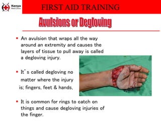 FIRST AID TRAINING
 An avulsion that wraps all the way
around an extremity and causes the
layers of tissue to pull away is called
a degloving injury.
 It’s called degloving no
matter where the injury
is; fingers, feet & hands,
 It is common for rings to catch on
things and cause degloving injuries of
the finger.
 