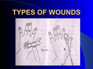 TYPES OF WOUNDS
 