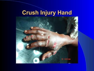 Crush Injury Hand
 