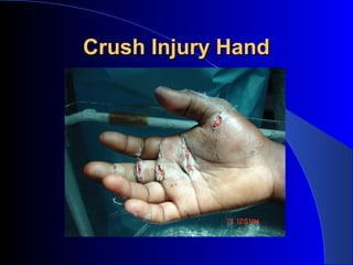 Crush Injury Hand
 