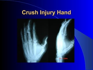 Crush Injury Hand
 