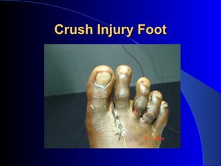 Crush Injury Foot
 