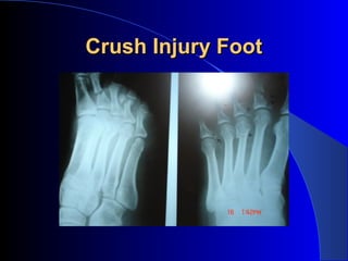 Crush Injury Foot
 