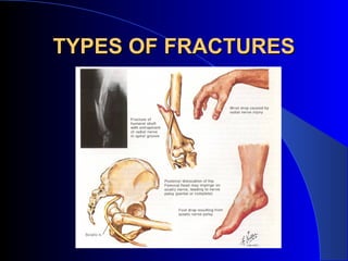 TYPES OF FRACTURES
 