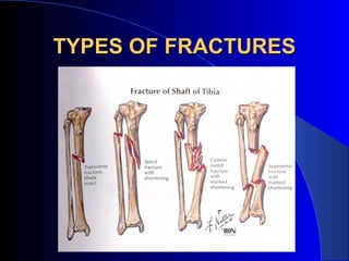 TYPES OF FRACTURES
 