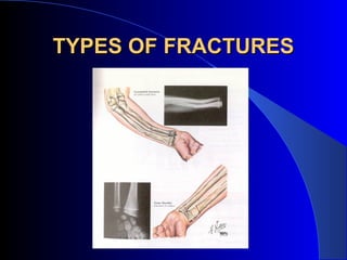 TYPES OF FRACTURES
 