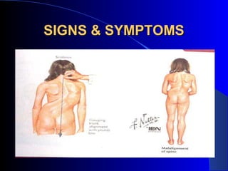 SIGNS & SYMPTOMS
 
