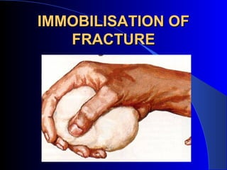 IMMOBILISATION OF
   FRACTURE
 