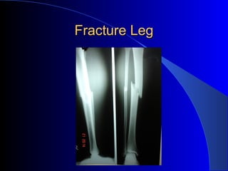 Fracture Leg
 