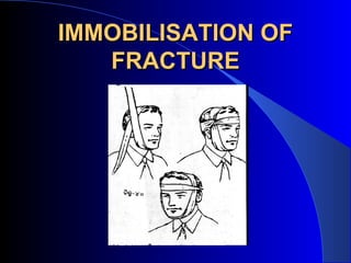 IMMOBILISATION OF
   FRACTURE
 
