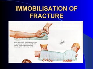 IMMOBILISATION OF
   FRACTURE
 