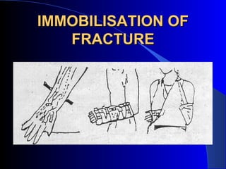 IMMOBILISATION OF
   FRACTURE
 