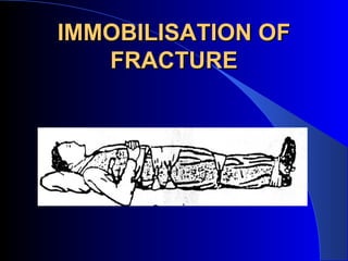 IMMOBILISATION OF
   FRACTURE
 