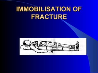 IMMOBILISATION OF
   FRACTURE
 