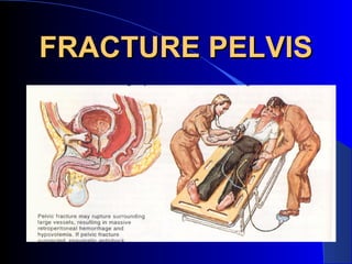 FRACTURE PELVIS
 
