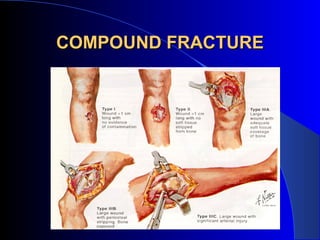 COMPOUND FRACTURE
 