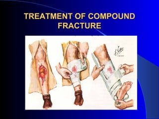 TREATMENT OF COMPOUND
      FRACTURE
 