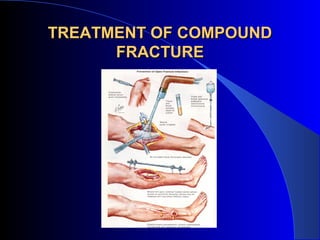 TREATMENT OF COMPOUND
      FRACTURE
 