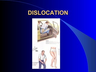 DISLOCATION
 