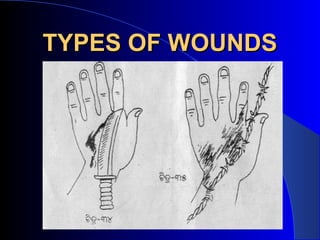 TYPES OF WOUNDS
 