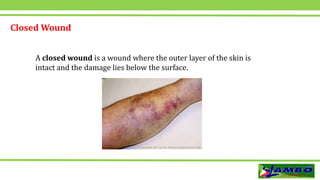 Closed Wound
A closed wound is a wound where the outer layer of the skin is
intact and the damage lies below the surface.
 