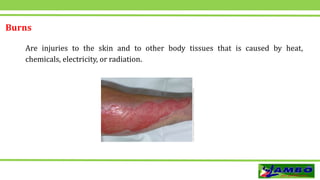 Burns
Are injuries to the skin and to other body tissues that is caused by heat,
chemicals, electricity, or radiation.
 