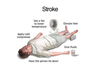 Stroke
 