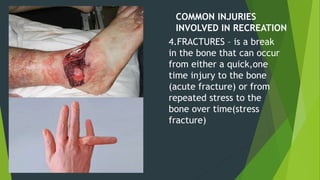 COMMON INJURIES
INVOLVED IN RECREATION
4.FRACTURES – is a break
in the bone that can occur
from either a quick,one
time injury to the bone
(acute fracture) or from
repeated stress to the
bone over time(stress
fracture)
 