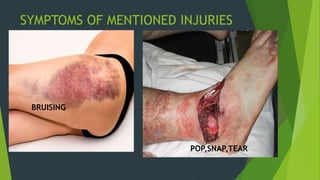SYMPTOMS OF MENTIONED INJURIES
BRUISING
POP,SNAP,TEAR
 
