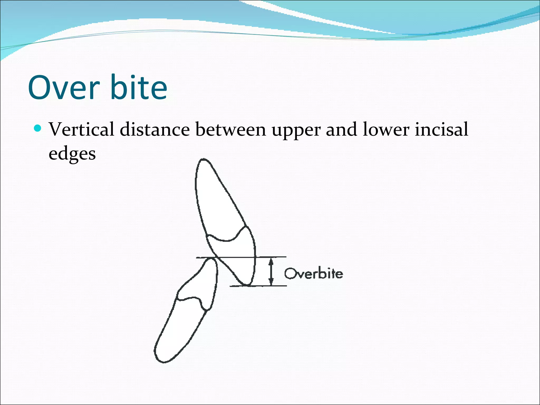 Over bite Vertical distance between upper and lower incisal edges 