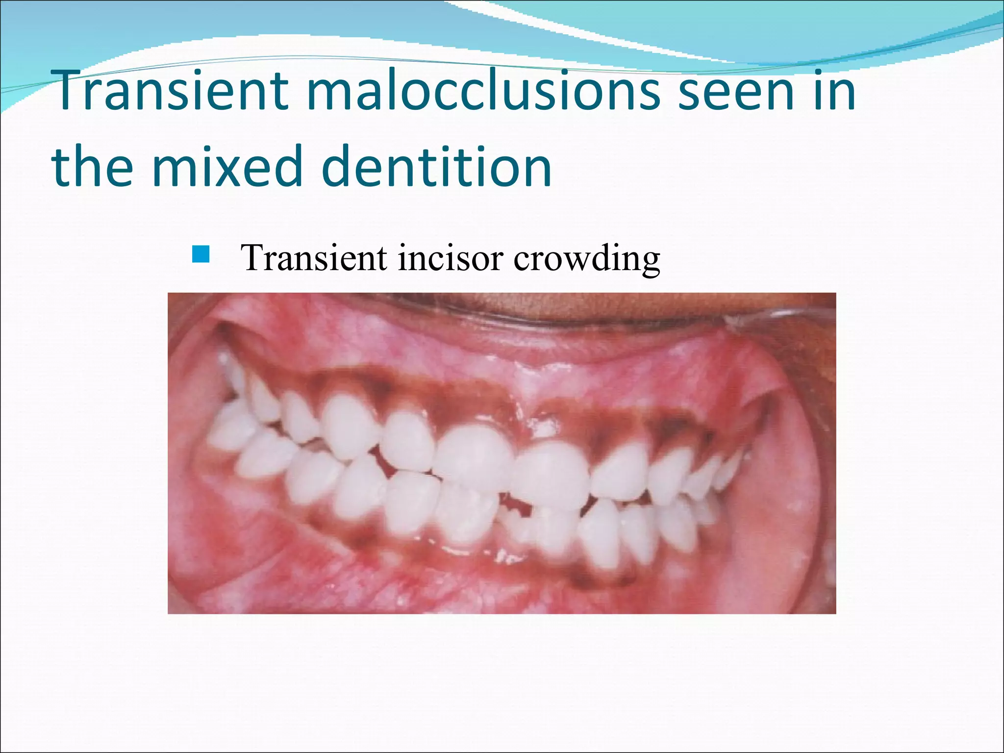 Transient malocclusions seen in the mixed dentition Transient incisor crowding 