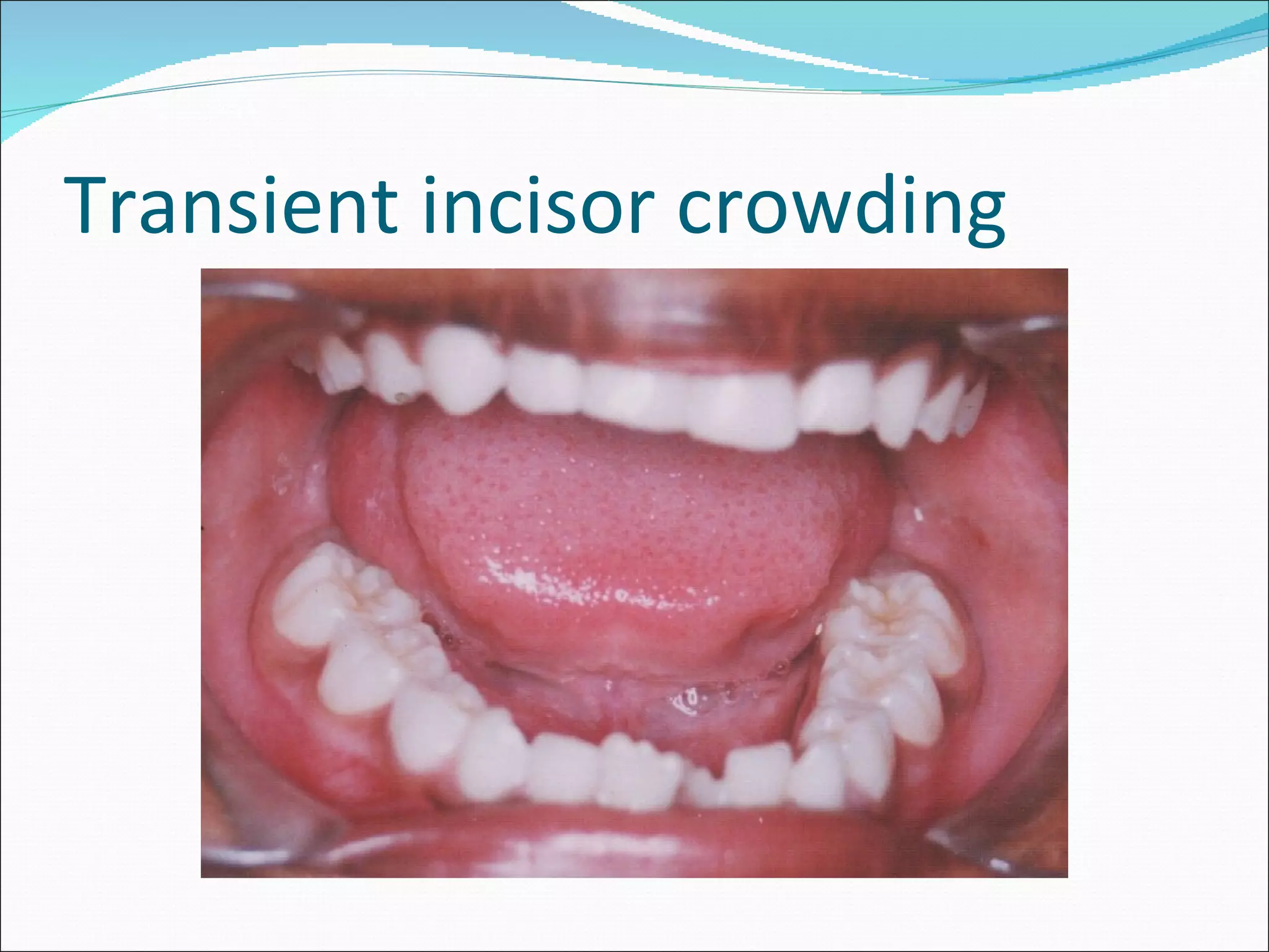 Transient incisor crowding 