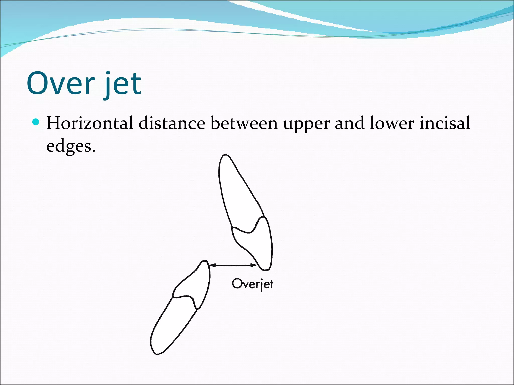 Over jet Horizontal distance between upper and lower incisal edges. 