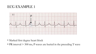 FIRST DEGREE AV BLOCK - first degree av bloch | PPTX