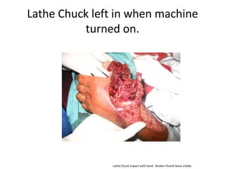 Lathe Chuck left in when machine
          turned on.




                Lathe Chuck impact with hand. Broken thumb bone visible.
 