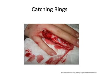 Catching Rings




           Actual incident was ring getting caught on a basketball hoop.
 