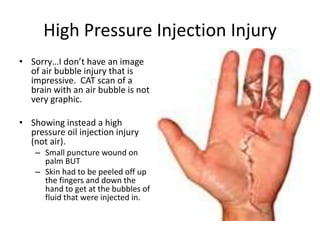High Pressure Injection Injury
• Sorry…I don’t have an image
  of air bubble injury that is
  impressive. CAT scan of a
  brain with an air bubble is not
  very graphic.

• Showing instead a high
  pressure oil injection injury
  (not air).
    – Small puncture wound on
      palm BUT
    – Skin had to be peeled off up
      the fingers and down the
      hand to get at the bubbles of
      fluid that were injected in.
 